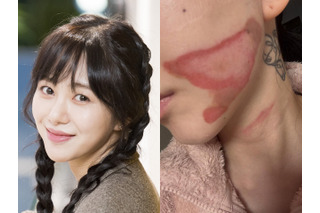 いまだに癒えぬ頬の大きなやけど痕…元K-POPアイドル、治療費稼ぐため美容皮膚科に転職 画像