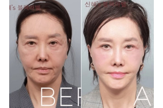限界ギリギリまで整形、60代とは思えないビジュアルに！韓国ベテラン女優の潔すぎる告白が話題 画像