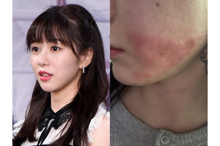 顔に残る“やけどの跡”…美容施術で医療事故被害の元K-POPアイドル、現状を公開「とても不安」 画像