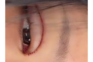 「地獄から」痛々しい手術痕…3度目となる目の整形手術を報告、父は元巨人投手の韓国インフルエンサー 画像