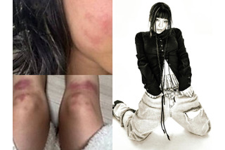 ボコボコに殴られた写真を投稿…交際していた男からのDV被害を主張した韓国女性ラッパー、所属事務所も支援へ 画像