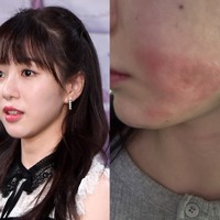 顔に残る“やけどの跡”…美容施術で医療事故被害の元K-POPアイドル、現状を公開「とても不安」