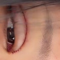 「地獄から」痛々しい手術痕…3度目となる目の整形手術を報告、父は元巨人投手の韓国インフルエンサー