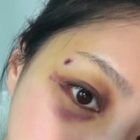 「殴られたのか？」結婚式1カ月前に何が…韓国恋リア出演女性、目の周りに青黒いあざの衝撃姿