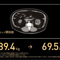 森永氏のダイエット前の腹部MRI