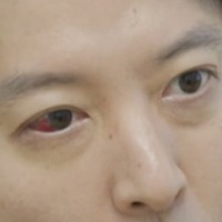 目が真っ赤に…「錐で刺されたように痛い」16歳下女優と熱愛のイ・ドンゴン、“1％の希少病”と診断