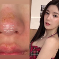 顔がズルむけ…「Ⅱ度のやけど」を負った“びしょ濡れフェスの女神”クォン・ウンビ、衝撃の近況を公開