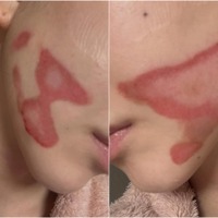 両頬に痛々しいやけど痕…元K-POPアイドルが医療事故被害を主張、訴訟へ「皮膚が裂けるような痛み」