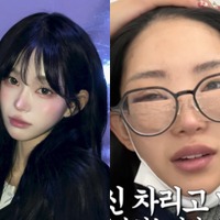 父は元巨人投手 韓国インフルエンサー、整形手術後の腫れた顔を赤裸々に公開