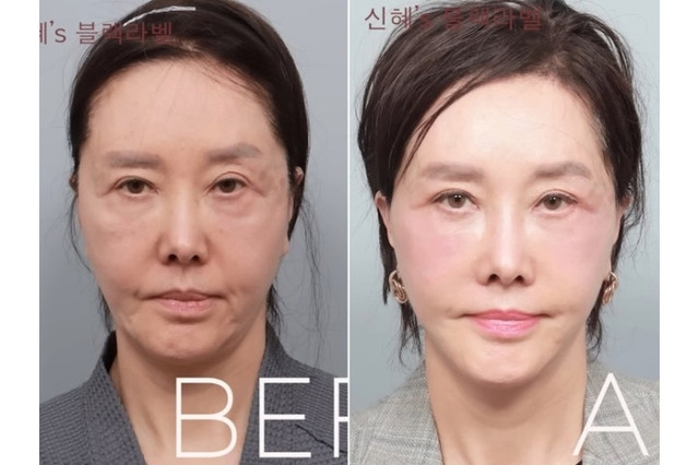 限界ギリギリまで整形、60代とは思えないビジュアルに！韓国ベテラン女優の潔すぎる告白が話題 画像