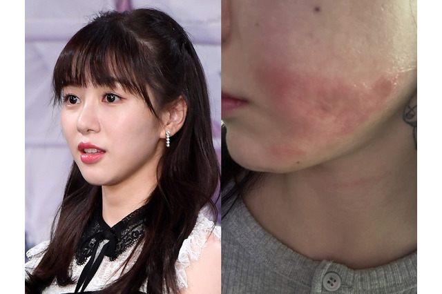 顔に残る“やけどの跡”…美容施術で医療事故被害の元K-POPアイドル、現状を公開「とても不安」 画像