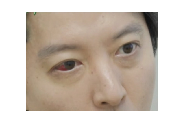 目が真っ赤に…「錐で刺されたように痛い」16歳下女優と熱愛のイ・ドンゴン、“1％の希少病”と診断 画像