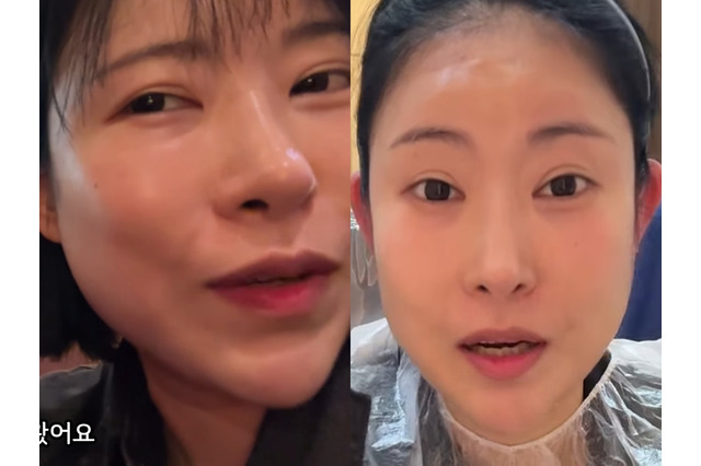 豊胸・整形に総額“1億5000万ウォン”投入の韓国芸人　今度は“耳”を改造「めちゃくちゃ不思議！」 画像