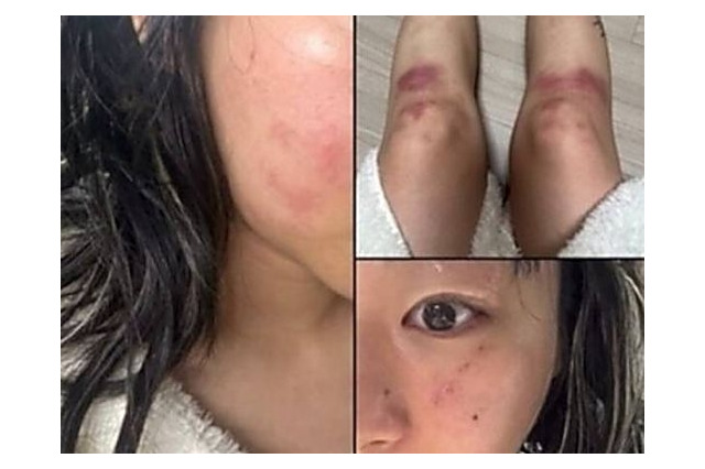顔は腫れ脚には痣…韓国女性ラッパーがDV被害を暴露、お相手は元恋人の音楽P　食い違う主張 画像