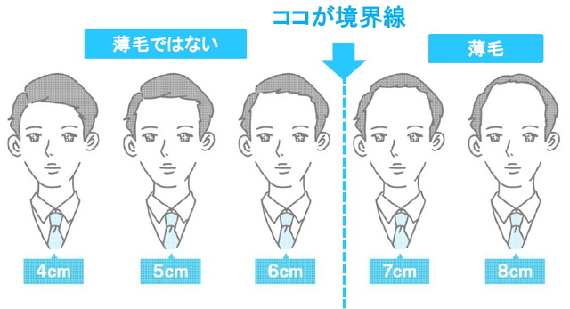 おでこの広さが何センチ以上になると薄毛だと思いますか？答