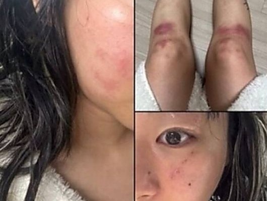 顔は腫れ脚には痣…韓国女性ラッパーがDV被害を暴露、お相手は元恋人の音楽P　食い違う主張