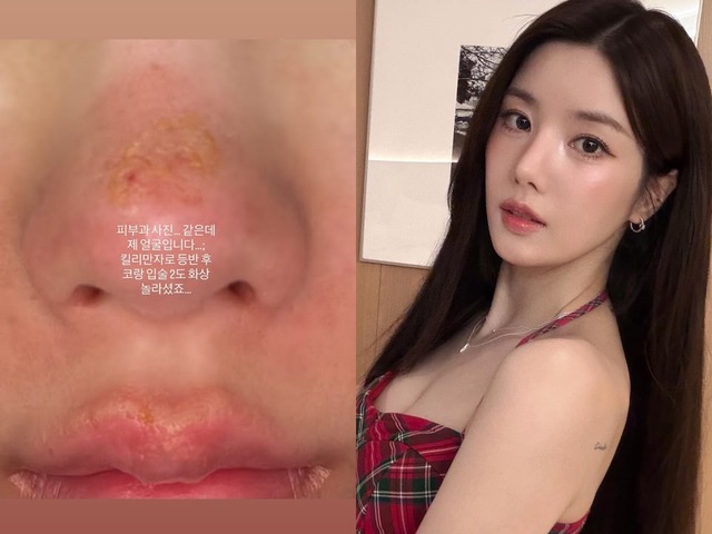 顔がズルむけ…「Ⅱ度のやけど」を負った“びしょ濡れフェスの女神”クォン・ウンビ、衝撃の近況を公開