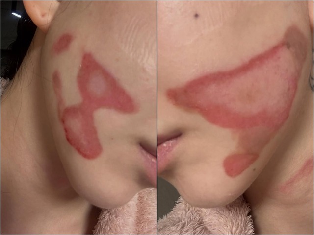 両頬に痛々しいやけど痕…元K-POPアイドルが医療事故被害を主張、訴訟へ「皮膚が裂けるような痛み」