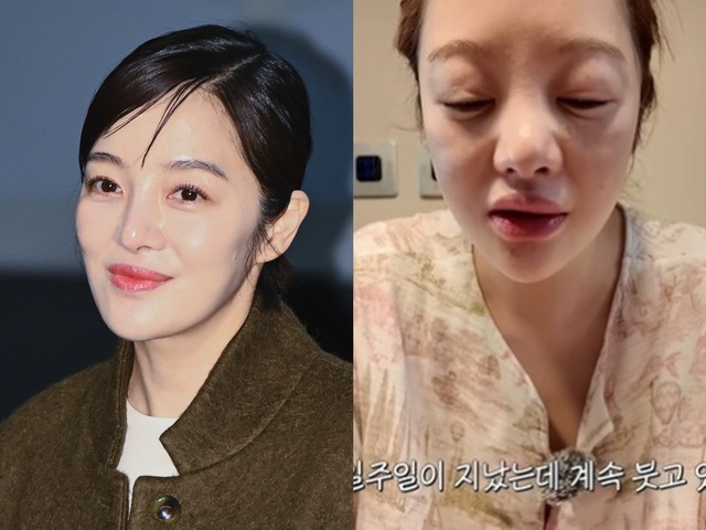 別人級に腫れた顔…『キム秘書』女優ファン・ボラ（42）、体外受精の副作用で健康悪化「体はボロボロ」