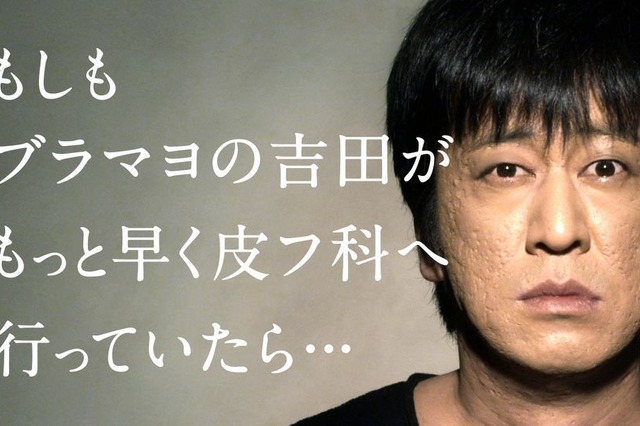 もしもブラマヨ吉田がもっと早く皮フ科へ行っていたら……? 画像