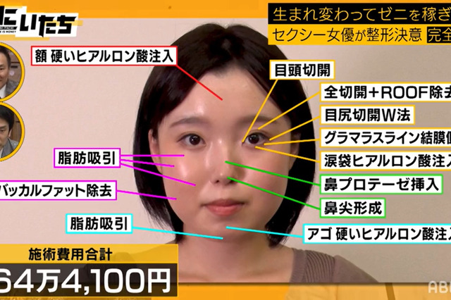 総額560万円の美容整形に密着！ビフォーアフターにかまいたち驚き「自信に満ちあふれてる」 画像