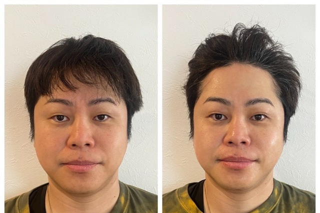 井上裕介、美容施術のビフォーアフターを公開 「顔が違う…」「やってみたいわ!」 画像