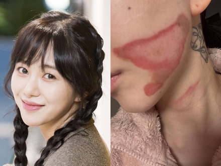 いまだに癒えぬ頬の大きなやけど痕…元K-POPアイドル、治療費稼ぐため美容皮膚科に転職