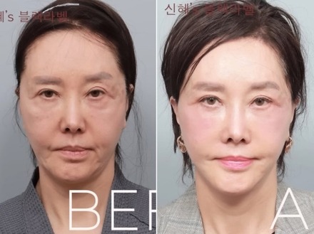 限界ギリギリまで整形、60代とは思えないビジュアルに！韓国ベテラン女優の潔すぎる告白が話題