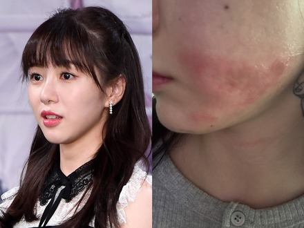 顔に残る“やけどの跡”…美容施術で医療事故被害の元K-POPアイドル、現状を公開「とても不安」