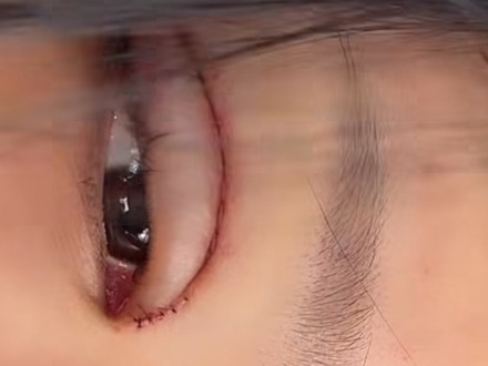 「地獄から」痛々しい手術痕…3度目となる目の整形手術を報告、父は元巨人投手の韓国インフルエンサー