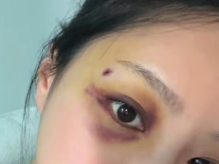 「殴られたのか？」結婚式1カ月前に何が…韓国恋リア出演女性、目の周りに青黒いあざの衝撃姿