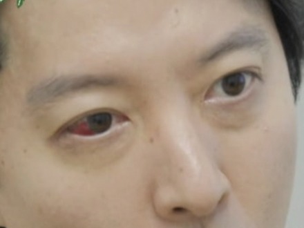 目が真っ赤に…「錐で刺されたように痛い」16歳下女優と熱愛のイ・ドンゴン、“1％の希少病”と診断