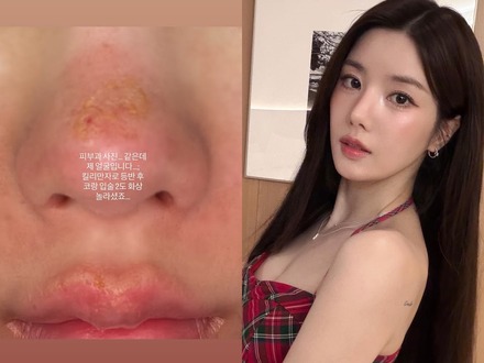 顔がズルむけ…「Ⅱ度のやけど」を負った“びしょ濡れフェスの女神”クォン・ウンビ、衝撃の近況を公開