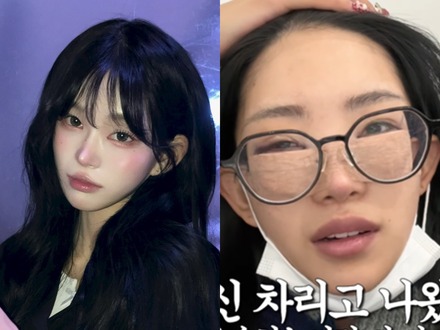 父は元巨人投手 韓国インフルエンサー、整形手術後の腫れた顔を赤裸々に公開