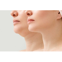 これまで治療法のなかった「首のしわ・たるみ」、国内初承認の医療機器「ソフウェーブ」で徹底検証。その症例を公開！