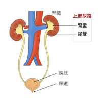 上部尿路（腎盂・尿管）がん術後の膀胱内再発予防にピラルビシン膀注療法が有効であることを証明